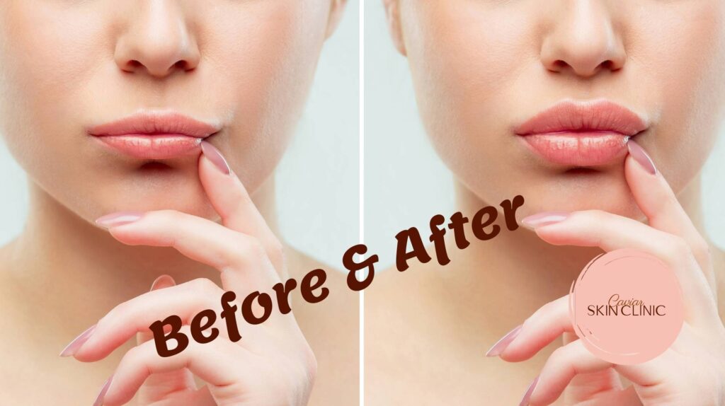 lip fillers Vancouver, lip injections before and after