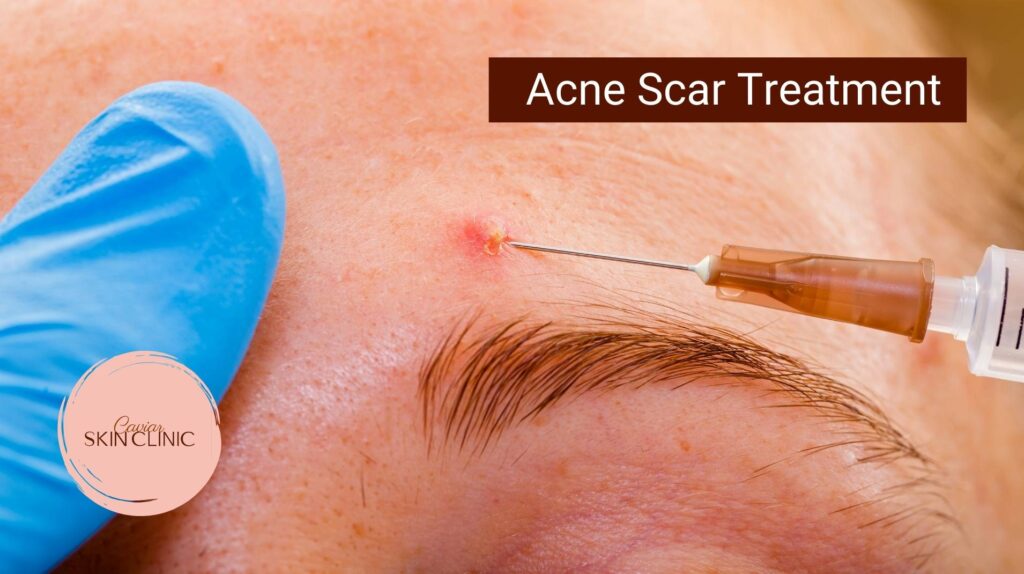 Acne Scars Treatments using PRP in Vancouver