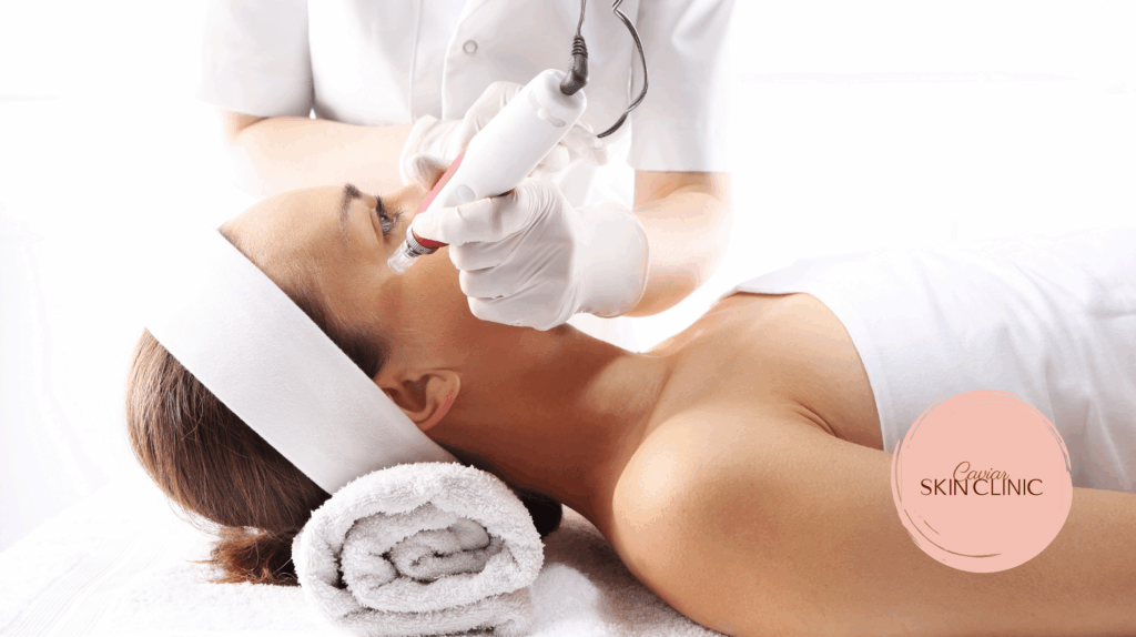 Microneedling treatments Vancouver